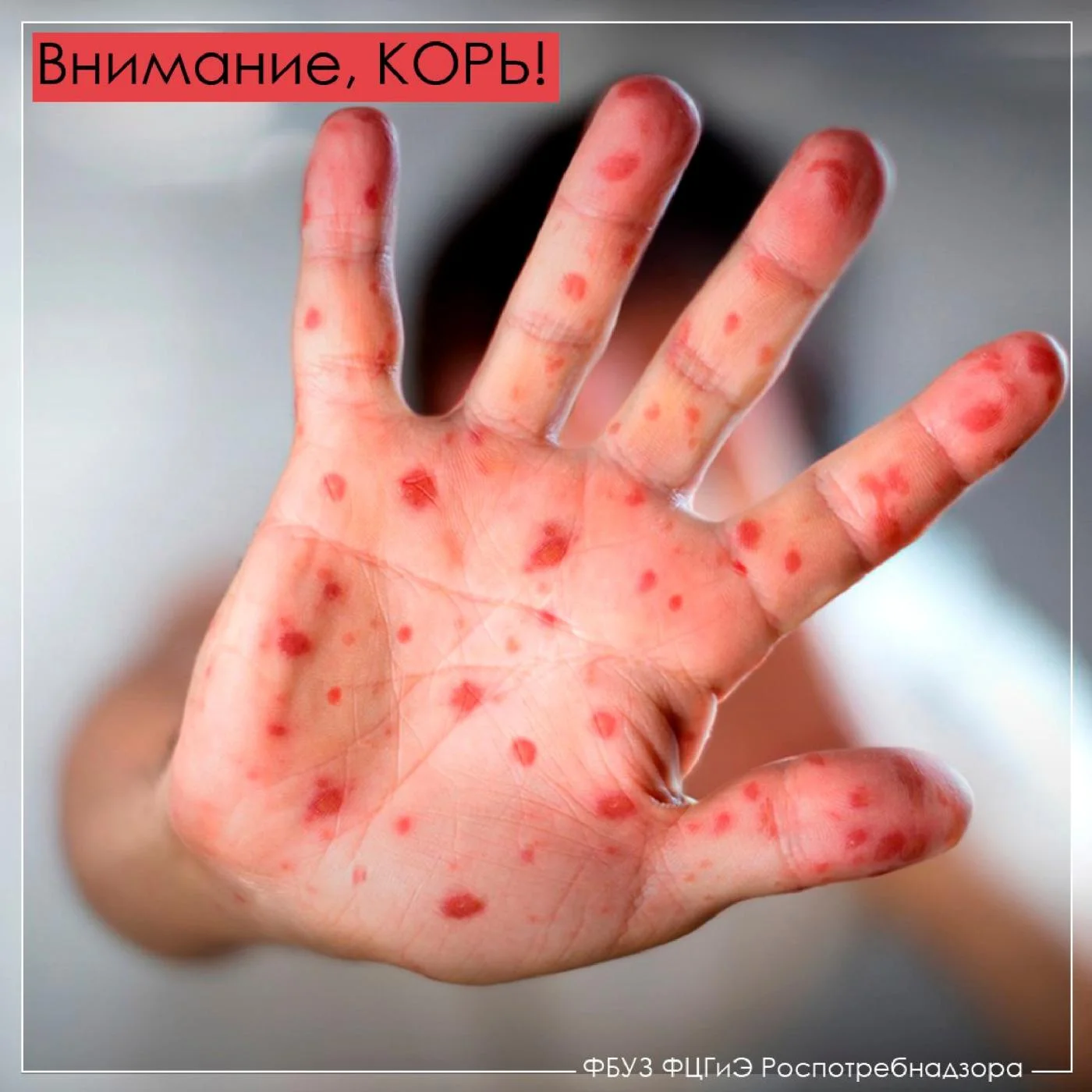Внимание! Корь!