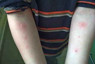 Самое время делать аллергопробы! Самое время делать аллергопробы!